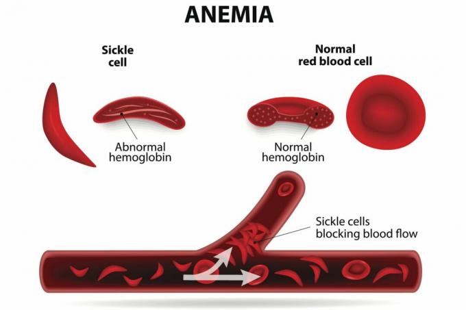 Sirprakuline aneemia